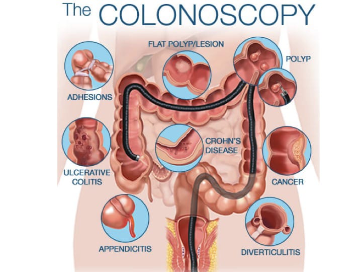 Doctor-explaining-colonoscopy