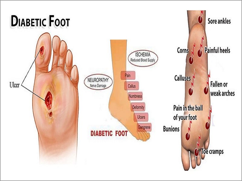 diabetic-foot-care-treatment