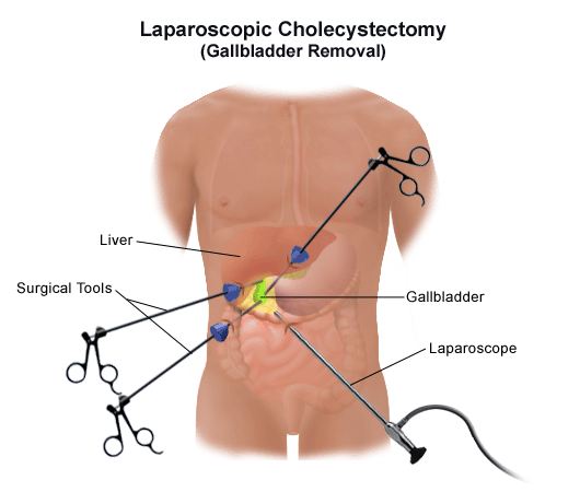 lap-cholecystectomy